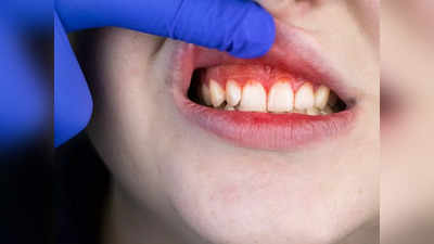 Oral health Ayurveda: मसूड़ों में खून, दांतों का पीलापन और दर्द से तुरंत राहत देंगे 5 आयुर्वेदिक घरेलू उपाय