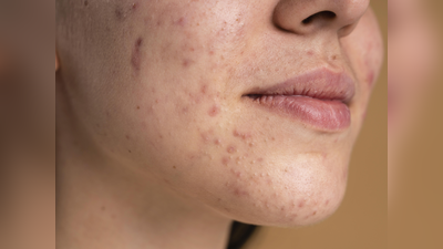 Acne Treatment: एक्सपर्ट से जानें मुहांसों को जड़ से खत्म करने के उपाय, बेदाग त्वचा के लिए रोजाना फॉलो करें ये रूटीन