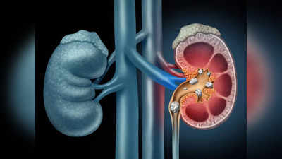 Kidney Stones: बिना ऑपरेशन और दर्द के किडनी की पथरी को पेशाब के साथ बाहर निकाल सकते हैं ये 8 तरह के जूस