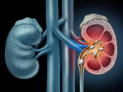 Kidney Stones: बिना ऑपरेशन और दर्द के किडनी की पथरी को पेशाब के साथ बाहर निकाल सकते हैं ये 8 तरह के जूस