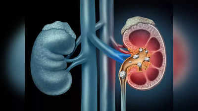 <strong>Kidney Stones :</strong> कोणत्याही औषधाशिवाय किडनी स्टोन अगदी सहज पडतील शरीरा बाहेर, करा ‘हे’ 8 साधेसोपे घरगुती उपाय! 