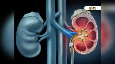 Kidney Stones: কিডনিতে পাথর? কাটাছেঁড়া ছাড়াই সমাধান এই ঘরোয়া উপায়ে!