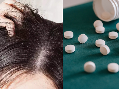 Aspirin Uses For Hair: डैंड्रफ के साथ-साथ कई हेयर प्रॉब्लम का इलाज है एस्पिरिन की गोलियां, बस इस तरीके से करें इस्तेमाल