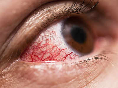 मुंह और नाक में नहीं, अब आंखों में भी घुस रहा है Omicron, मरीजों में नजर आ रहे हैं ये 5 गंभीर लक्षण