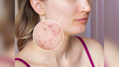 Teenage Acne Treatment: मुंहासों की वजह से हर जगह शर्मिंदा हो रहा है आपका टीनेज बच्चा, तो न्यूट्रिशनिस्ट की ये सलाह आ सकती है आपके काम