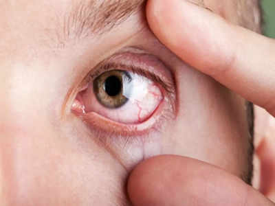 Symptoms of High Cholesterol: कोलेस्ट्रॉल बढ़ते ही आंखों पर दिखते हैं ऐसे लक्षण, पहली फुर्सत में ही करवाएं चेकअप