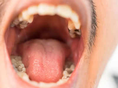 Mouth Cancer: शुरुआती स्टेज में नहीं पता चलता माउथ कैंसर का, डॉ. ने कहा- मुंह ना खुले तो हो जाएं सावधान