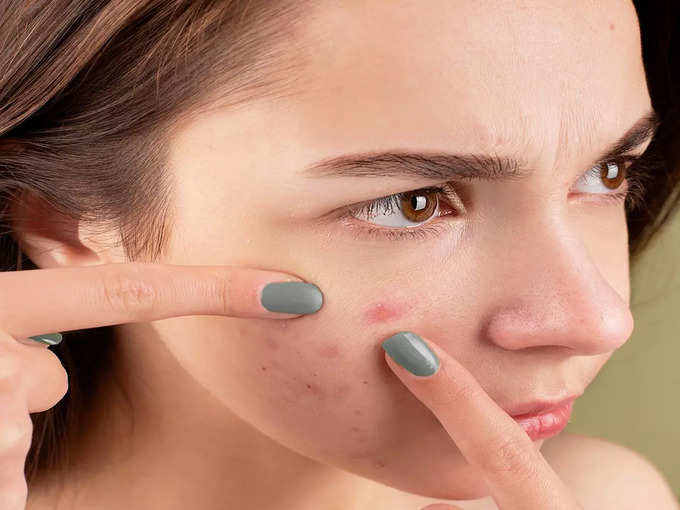 Pimples Remover: রাতারাতি দূর হবে ব্রণর সমস্যা! শুধু ত্বকে লাগান এই জিনিস!