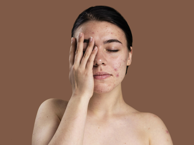 Acne Treatment: इन 5 हेल्दी ड्रिंक्स से हफ्ते भर में चेहरे से गायब होने लगेंगे मुंहासे, फेस पर देखने को मिलेगा नेचुरल ग्लो