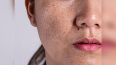 Pigmentation Problem: 35 की उम्र में ही दिखने लगी हैं चेहरे पर झाइयां, एक्सपर्ट ने बताए इसके बेस्ट इलाज