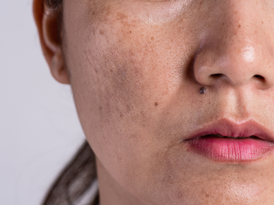 Pigmentation Problem: 35 की उम्र में ही दिखने लगी हैं चेहरे पर झाइयां, एक्सपर्ट ने बताए इसके बेस्ट इलाज