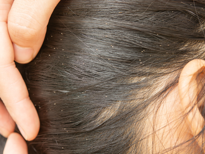 Tips To Remove Nits From Hair: इन 5 घरेलू चीजों से मिट जाएगा लीख का नामो निशान, एक ही दिन में मिलेगा इससे छुटकारा