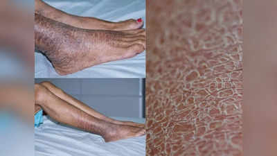 Ichthyosis vulgaris: एक ऐसी बीमारी जिसमें सांप की तरह बनती रहती है मरीज की खाल, जानिए किन्हें है इसका खतरा