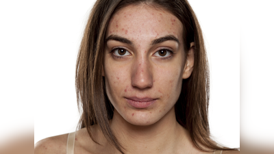 Pimple Treatment:ग्लो की जगह चेहरे पर दिखते हैं सिर्फ पिंपल ही पिंपल? इससे छुटकारा पाने के लिए खाली पेट खाएं ये चीजें