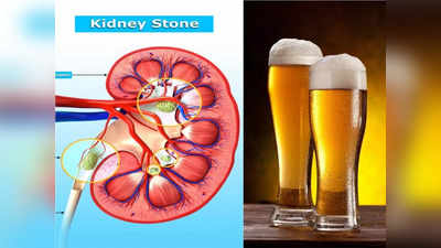 World Kidney Day: Beer पीने से जल्दी बाहर निकल जाती है बड़ी से बड़ी किडनी की पथरी?