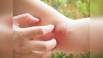 heat rash :வியர்க்குருவை விரட்டும் 12 வழிகள், எல்லாமே பாதுகாப்பானது!