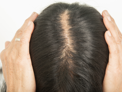 Hair Care Tips: सिर से गायब हो चुके बाल फिर से आएंगे वापस, बस इस तरीके से इस्तेमाल करें सरसों की खली