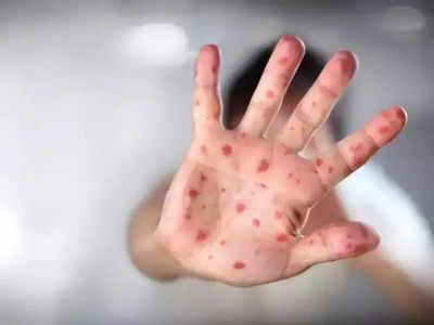 Infectious Diseases: ની જેમ સંક્રામક છે આ 4 રોગ, છીંક-ઉધરસ સહિત જકડી લે છે શરીર 