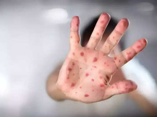 Infectious Diseases: ની જેમ સંક્રામક છે આ 4 રોગ, છીંક-ઉધરસ સહિત જકડી લે છે શરીર 