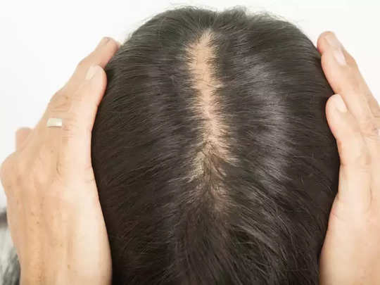 Hair Growth Tips: માથામાંથી ગાયબ થઈ ગયેલા વાળ આવશે પાછા, બસ આ રીતે કરો મસ્ટર્ડ કેકનો ઉપયોગ 