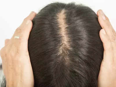 Hair Growth Tips: માથામાંથી ગાયબ થઈ ગયેલા વાળ આવશે પાછા, બસ આ રીતે કરો મસ્ટર્ડ કેકનો ઉપયોગ