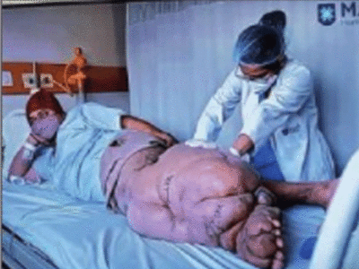 Delhi News: पैर का वजन 45 किलो, 10 साल से थे परेशान, सर्जरी के बाद मरीज ‘चलने को तैयार’
