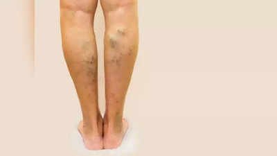 varicose veins remedies  : வெரிகோஸ் வெயினை குணமாக்கும் ஆயுர்வேத வைத்தியம்!