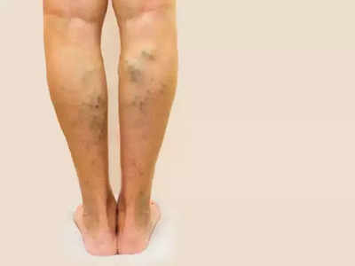 varicose veins remedies  : வெரிகோஸ் வெயினை குணமாக்கும் ஆயுர்வேத வைத்தியம்!