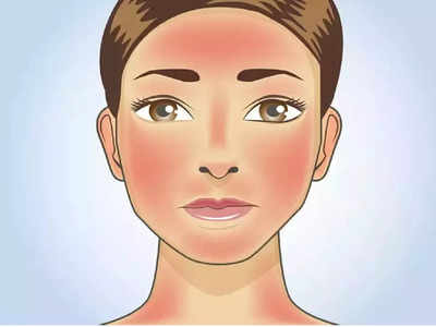 skin rashes :  வெப்பத்தினால் வரும் ஸ்கின் ரேஷஷ்  தடுக்க என்னலாம் செய்யணும் தெரியுமா?