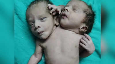 2 सिर और 3 हाथ के साथ हुआ बच्चे का जन्म, आईसीयू में लड़ रहा है जिंदगी की जंग!