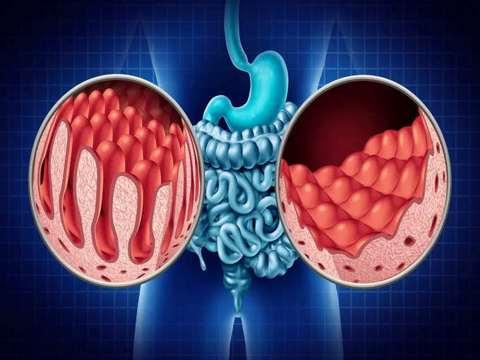 सीलिएक रोग के लक्षण (Symptoms of Celiac disease)