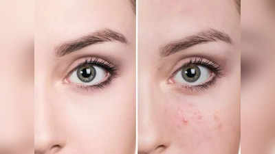 pimple marks:  பருக்களால் உண்டாகும் தழும்புகளை போக்க  இந்த வீட்டு வைத்தியம் ட்ரைபண்ணுங்க!