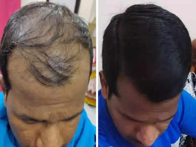 Hair Transplant Surgery : பிறக்கும் போதே முடி இல்லாதவர்கள் முடி மாற்று அறுவை சிகிச்சை செய்யலாமா? யாரெல்லாம் தவிர்க்கணும்?