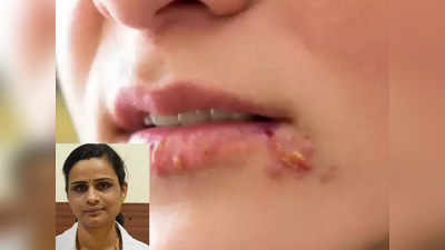 herpes remedies : ஹெர்பஸ் என்னும் வாய்ப்புண்,குளிர்புண் பிரச்சனைக்கு உதவும் வீட்டு வைத்தியம்!