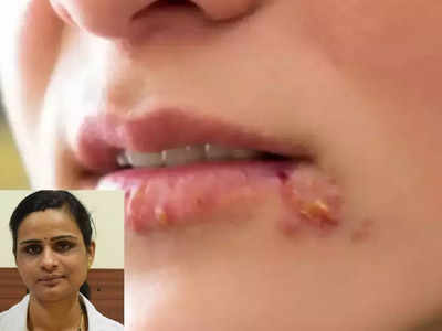 herpes remedies : ஹெர்பஸ் என்னும் வாய்ப்புண்,குளிர்புண் பிரச்சனைக்கு உதவும் வீட்டு வைத்தியம்!