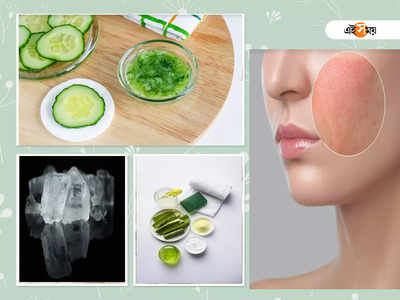 Home Remedies For Sunburn: ছাতা, সানস্ক্রিন ব্যবহার করেও সানবার্ন? ঘরোয়া উপায়েই দূর করুন...