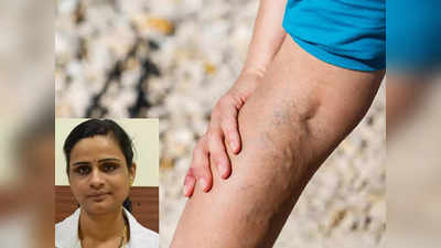 varicose veins : உடம்பெல்லாம் நரம்பு சுருட்டி பச்சையா நீலமா இருக்கா, வசம்பு கற்றாழையும் இப்படி யூஸ் பண்ணுங்க!