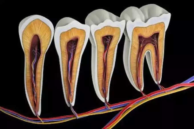 ​Dental caries म्हणजे काय?
