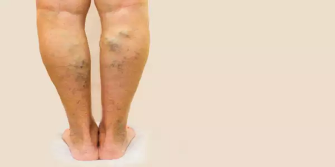 VARICOSE VEIN