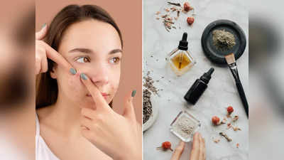 Skin care: चेहरे पर दिखते हैं जबरदस्त मुंहासे तो कुछ भी लगाने की ना करें गलती, सिर्फ एक्सपर्ट की बताई इन 3 चीजों को करें ट्राई