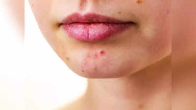 acne prevent diet: முகப்பரு வராம இருக்க என்ன செய்யணும்? இதை தான் ஃபாலோ பண்ணனும்!