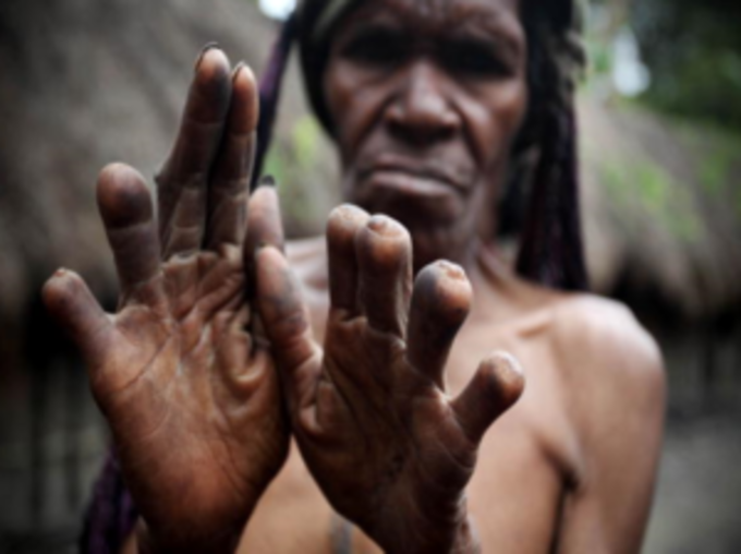 पापुआ न्यू गिनी में उंगली काटने का रिवाज