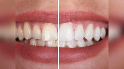 Natural Teeth Whitening: হাসিতে যেন মুক্তো ঝরে! দাঁত ঝকঝকে করার ঘরোয়া উপায় কী?