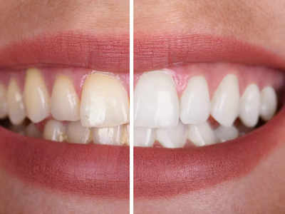 Natural Teeth Whitening: হাসিতে যেন মুক্তো ঝরে! দাঁত ঝকঝকে করার ঘরোয়া উপায় কী?