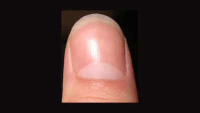 White Spot on Nails, नाखूनों पर सफेद निशान, जानें क्या कहता है हस्तरेखा विज्ञान