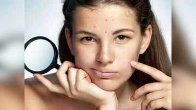 sweat pimples : வியர்வையால் வரும் பருக்களை தடுக்க இதை செய்யுங்க!