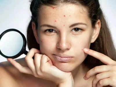 sweat pimples : வியர்வையால் வரும் பருக்களை தடுக்க இதை செய்யுங்க!