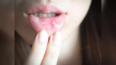 mouth ulcer symptoms: வாய்ப்புண் யாருக்கெல்லாம் ஏற்படும்? என்னென்ன காரணங்களால் வரும்...