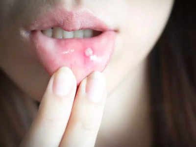 mouth ulcer symptoms: வாய்ப்புண் யாருக்கெல்லாம் ஏற்படும்? என்னென்ன காரணங்களால் வரும்...