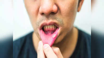 Mouth Ulcer Home Remedies: মুখের ঘায়ে কষ্ট পাচ্ছেন? ঘরোয়া উপায়ে সমস্যা মিটিয়ে নিন